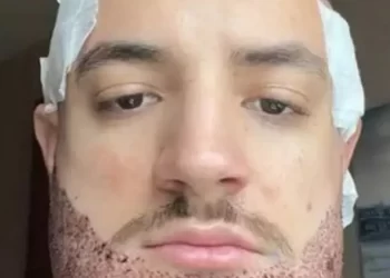 Un joven muere tras someterse a un trasplante de barba fallido en Turquía