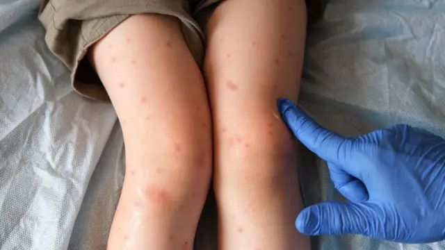 “No hay ninguna complicación en revacunarse”: experto insiste ante riesgo de sarampión en Colombia